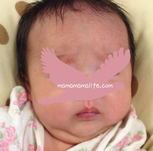 新生児ニキビ　治療中　改善　乳児湿疹